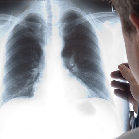 Manifestari pulmonare intilnite in cursul unor boli generale sau de sistem
